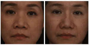 Before and after image of woman with subtle changes after rhinoplasty